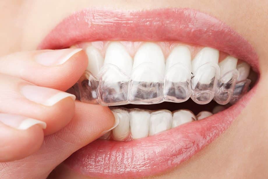 Can You Eat With Invisalign?