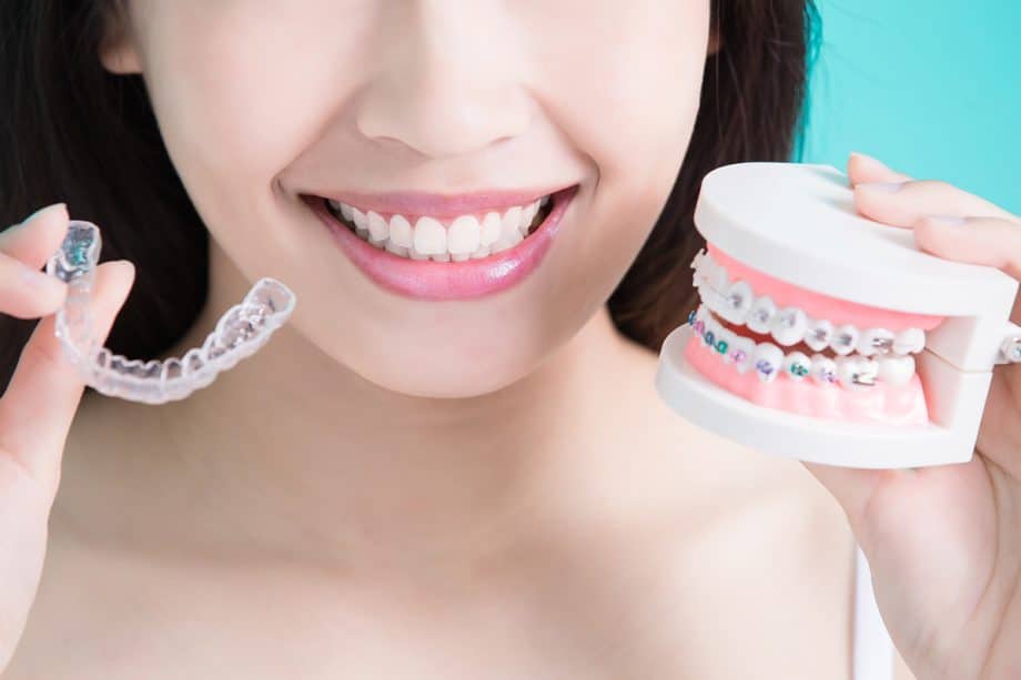 How Long Do Braces Take to Straighten Teeth?